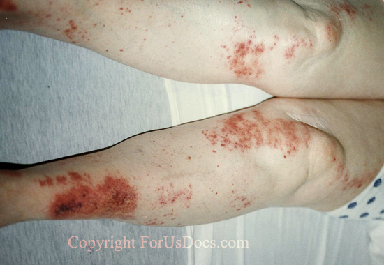 Vasculitis secondary to Cryoglobulinemia
