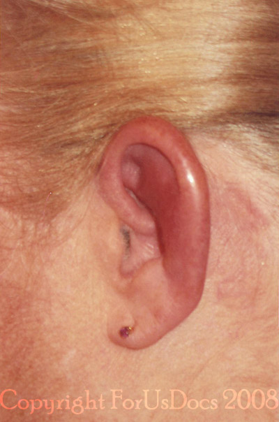 Relapsing Polychondritis